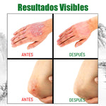 Crema Antifúngica y Antipicazón – Tratamiento Natural para Tiña, Hongos y Psoriasis