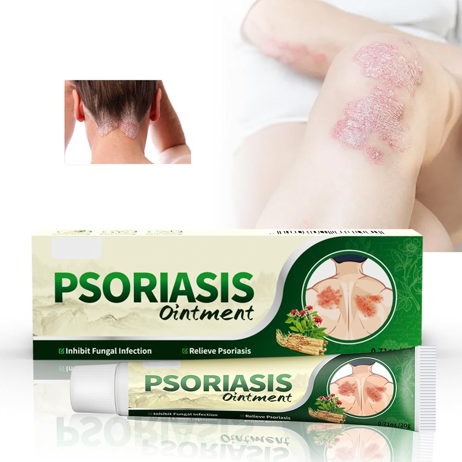 Crema Antifúngica y Antipicazón – Tratamiento Natural para Tiña, Hongos y Psoriasis