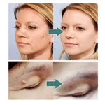 2X1/ FormuClear™ - Elimina verrugas sin dolor y seguro + ENVIO GRATIS